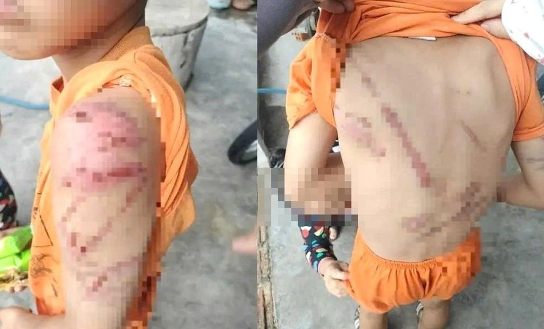 Xử phạt người bố đánh con trai 9 tuổi bầm tím