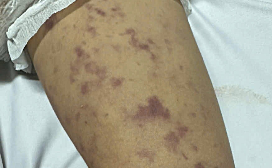 Một bệnh nhi ở Đắk Lắk tử vong do mắc viêm não mô cầu