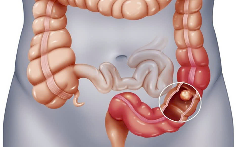 Nội soi định kỳ - “Vũ khí số 1” trong cuộc chiến chống ung thư tiêu hóa