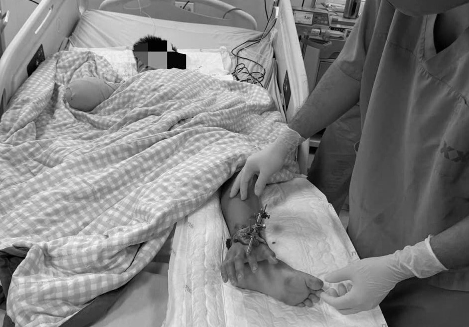 Ghép tạm bàn tay vào chân chờ hồi phục, ghép nối