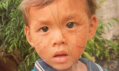 Khuôn mặt cháu Tiến bị Lê Thị Thanh Dung dùng kéo rạch nát mặt. 