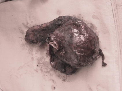 Bệnh nhân nghiện thuốc lá bị u phổi to như trái bưởi