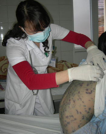 Phân biệt sởi và thủy đậu