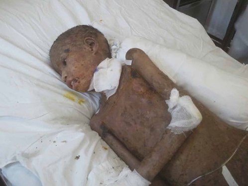 Khó cứu được đôi mắt nạn nhân ma rừng