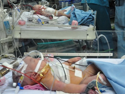 Kịch tính căng não trong ca tách cặp song sinh dính ngực