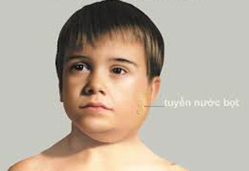 Biến chứng khi bị quai bị là gì