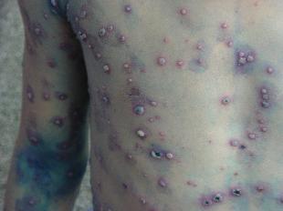 Hà Nội vẫn chưa có vaccin ngừa thủy đậu