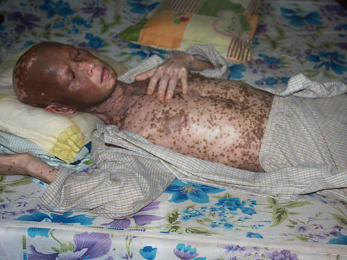 Ăn thịt chó có thể tử vong