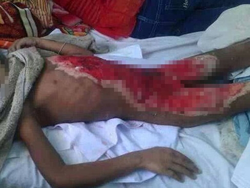 Nướng ngô, bé 6 tuổi bị bỏng toàn thân