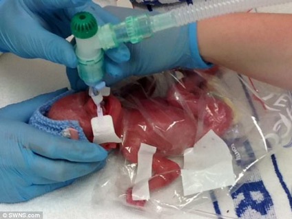 Bé tí hon sống sót nhờ túi đựng bánh