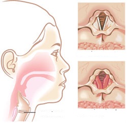 Thanh quản bình thường (trên) và tổn thương viêm thanh quản (dưới).