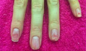 Cụt móng vì dùng sơn phủ giá rẻ