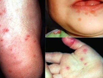 Bộ Y tế lập 5 đoàn kiểm tra bệnh tay chân miệng