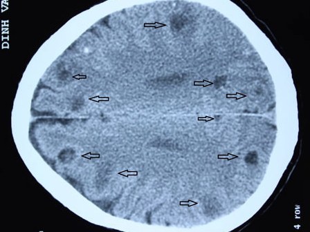 Phát hiện gần 50 ổ sán trong não bệnh nhân