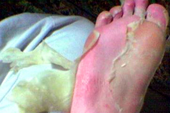 Phát hoảng với mặt nạ da chân gây tê buốt