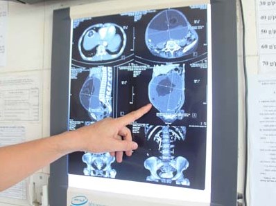 Phẫu thuật khối u buồng trứng nặng hơn 6kg