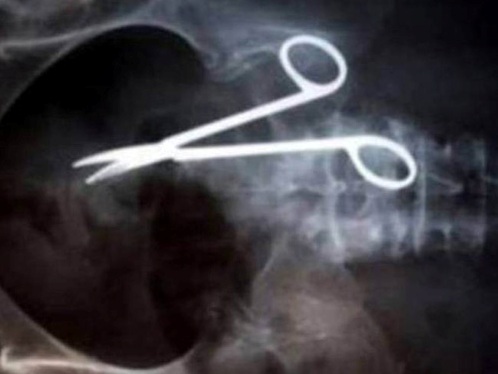 Kéo mắc trong bụng suốt 9 năm