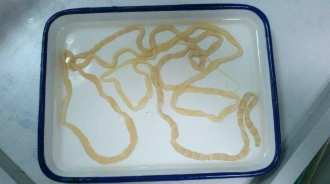 Kinh hoàng con sán dây dài 2,5m trong dạ dày người phụ nữ