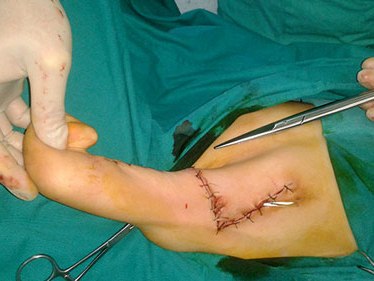 Phẫu thuật dị tật thành công cho con chiến sĩ Trường Sa