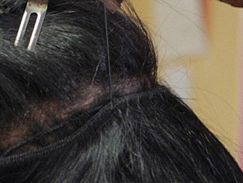 Bị giòi chui vào da đầu sau khi nối tóc