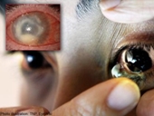 Bị amip ăn mắt do mang kính áp tròng suốt 6 tháng