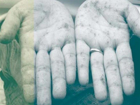 Nước nhiễm asen nguy hiểm thế nào