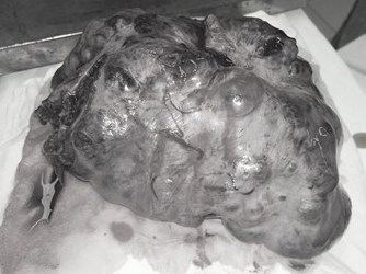 Cứu sống bé 13 tuổi bị vỡ u quái buồng trứng