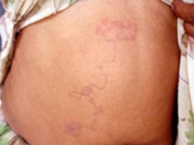 Sống giữa thủ đô vẫn bị giun bò khắp người