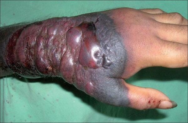 Bàn tay của bệnh nhân bị nhiễm virus Ebola