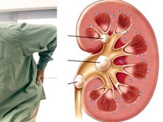 Sỏi thận Những biến chứng nguy hiểm