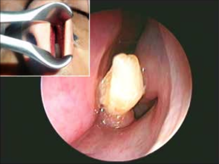 Kỳ lạ răng… mọc trong mũi