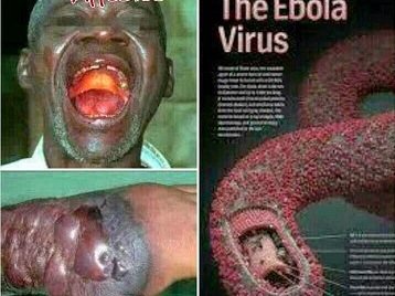 Bạn biết gì về dịch bệnh Ebola