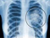 Dấu hiệu cảnh báo sớm bệnh ung thư phổi