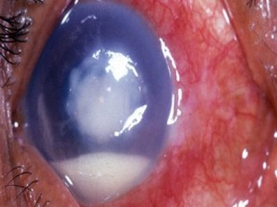 Thiếu nữ mang sẹo trong mắt vì kính áp tròng