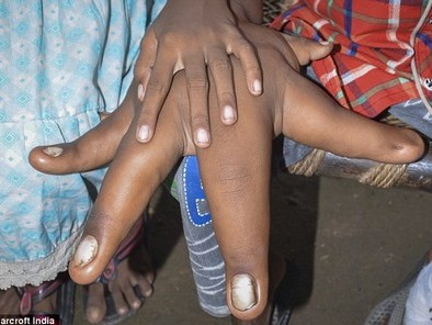 Cậu bé sở hữu đôi bàn tay khổng lồ kỳ lạ