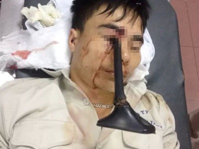 Cầm ô đi xe máy, thanh niên bị cán gương đâm xuyên mắt