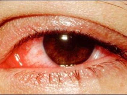 Tháng 9 Dân công sở cẩn trọng lây đau mắt đỏ