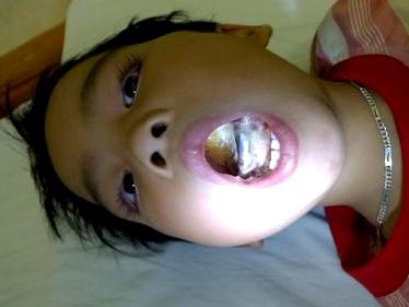 Bé 6 tuổi cháy lưỡi vì ngậm phích cắm điện