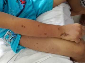 Ong vò vẽ đốt Người chết, người nôn ra máu