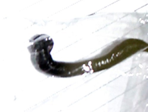 Đỉa sống trong thanh quản cháu bé 11 tuổi