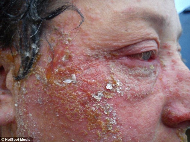 Mù màu vì thuốc nhuộm tóc