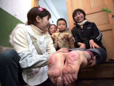 Người phụ nữ với đôi bàn chân xoay ngược