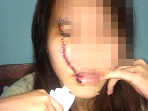 Cô gái bị nữ sinh 16 tuổi rạch mặt giữa đường