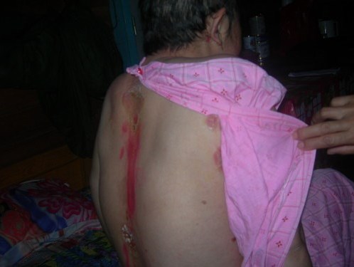 Nhiễm độc asen vì chữa vẩy nến bằng thuốc xách tay từ Campuchia