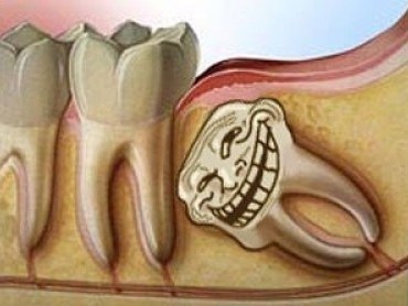 Vì sao phần lớn răng khôn phải nhổ bỏ