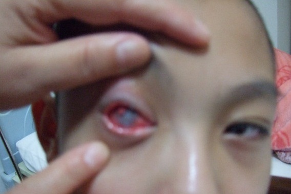 Trẻ 5 tuổi mù mắt vì gói chống ẩm