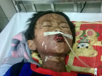 Bé trai nổi bọng nước toàn thân, lở loét vì quả dại