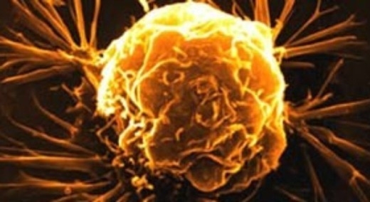 Những triệu chứng không ngờ báo trước bệnh ung thư từ 2 - 5 năm