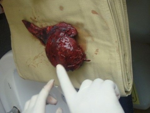 Việt kiều nhập viện vì phổi tràn ngập sán