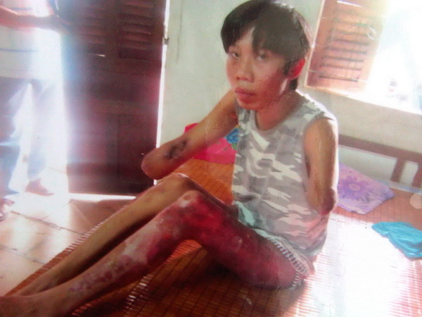 Mơ ước có được cánh tay nhân tạo